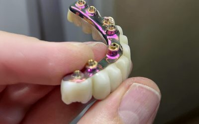 İmplant Üstü Protezlerde Sürdürülebilir Çözüm: TiBarTech Titanyum Bar Sistemleriyle Hasta Konforunu Artırın